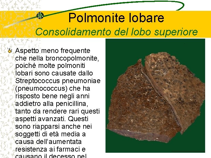 Polmonite lobare Consolidamento del lobo superiore Aspetto meno frequente che nella broncopolmonite, poiché molte