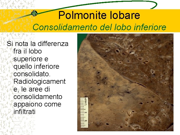 Polmonite lobare Consolidamento del lobo inferiore Si nota la differenza fra il lobo superiore