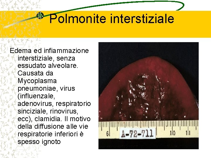 Polmonite interstiziale Edema ed infiammazione interstiziale, senza essudato alveolare. Causata da Mycoplasma pneumoniae, virus