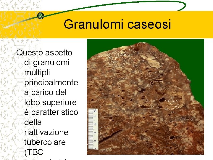 Granulomi caseosi Questo aspetto di granulomi multipli principalmente a carico del lobo superiore è