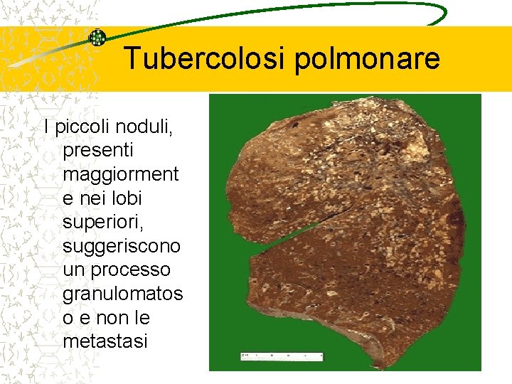 Tubercolosi polmonare I piccoli noduli, presenti maggiorment e nei lobi superiori, suggeriscono un processo