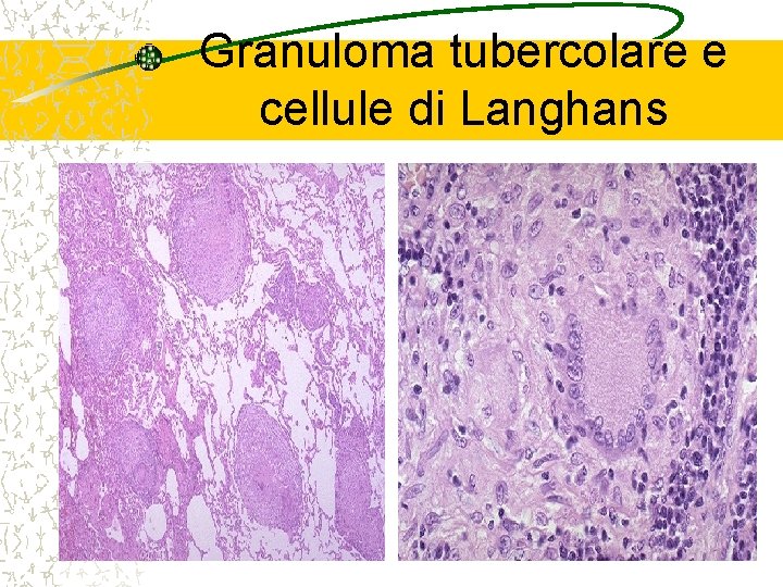 Granuloma tubercolare e cellule di Langhans 