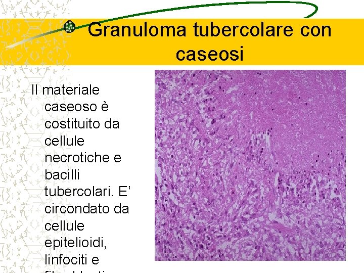 Granuloma tubercolare con caseosi Il materiale caseoso è costituito da cellule necrotiche e bacilli