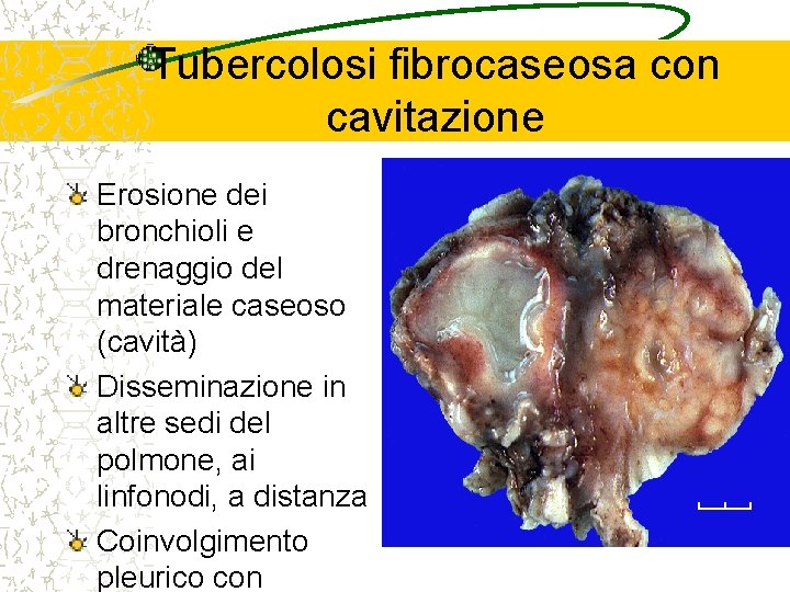 Tubercolosi fibrocaseosa con cavitazione Erosione dei bronchioli e drenaggio del materiale caseoso (cavità) Disseminazione