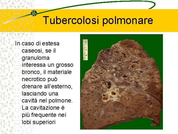 Tubercolosi polmonare In caso di estesa caseosi, se il granuloma interessa un grosso bronco,