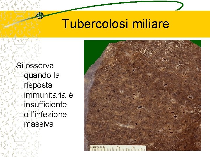 Tubercolosi miliare Si osserva quando la risposta immunitaria è insufficiente o l’infezione massiva 