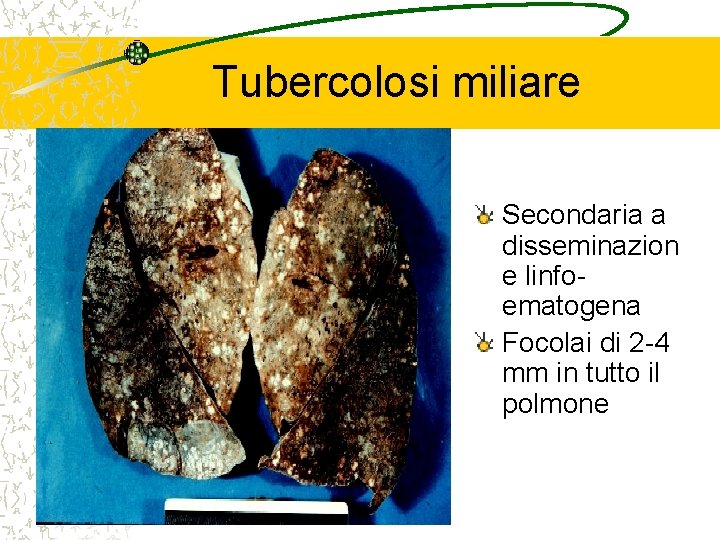 Tubercolosi miliare Secondaria a disseminazion e linfoematogena Focolai di 2 -4 mm in tutto