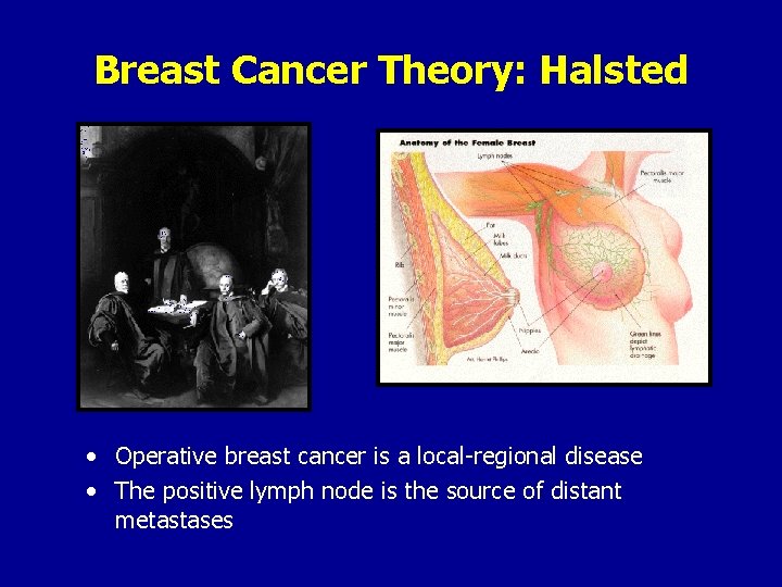 Breast Cancer Theory: Halsted • Operative breast cancer is a local-regional disease • The
