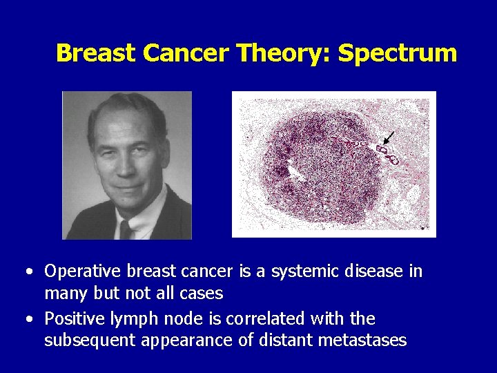 Breast Cancer Theory: Spectrum • Operative breast cancer is a systemic disease in many