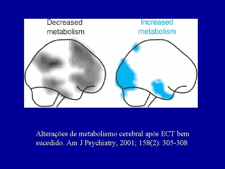 Alterações de metabolismo cerebral após ECT bem sucedido. Am J Psychiatry, 2001; 158(2): 305