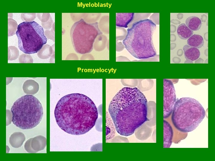 Myeloblasty Promyelocyty 