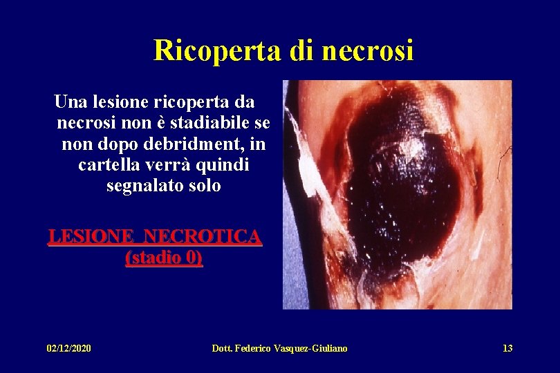 Ricoperta di necrosi Una lesione ricoperta da necrosi non è stadiabile se non dopo