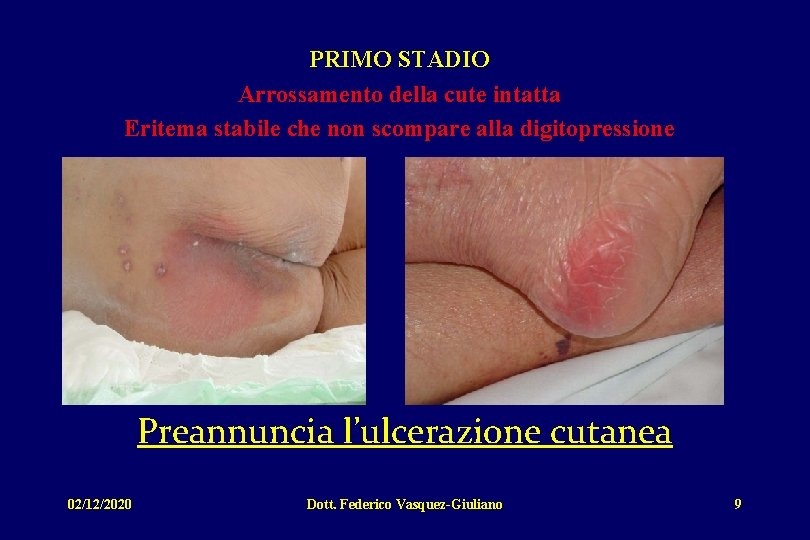 PRIMO STADIO Arrossamento della cute intatta Eritema stabile che non scompare alla digitopressione Preannuncia