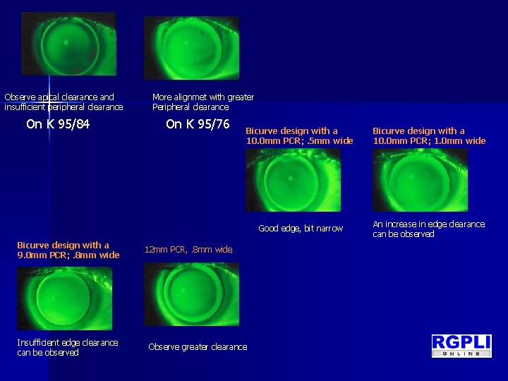 Observe apical clearance and insufficient peripheral clearance On K 95/84 Bicurve design with a