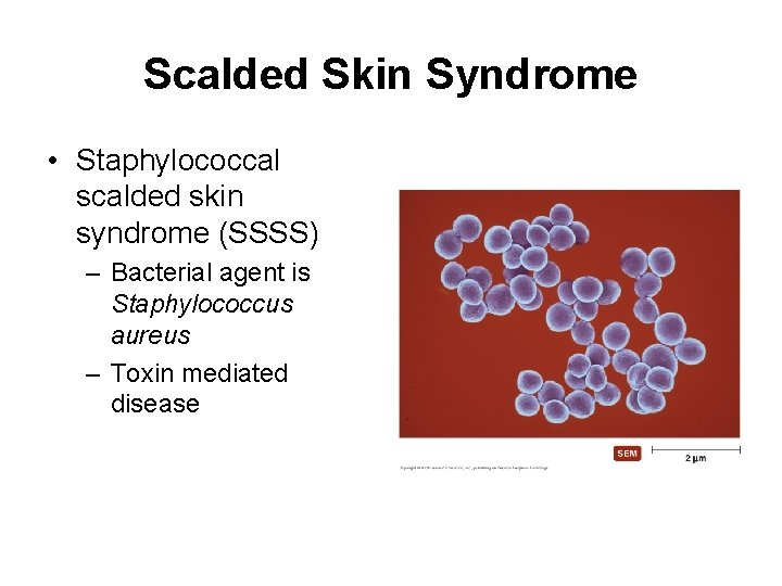 Scalded Skin Syndrome • Staphylococcal scalded skin syndrome (SSSS) – Bacterial agent is Staphylococcus