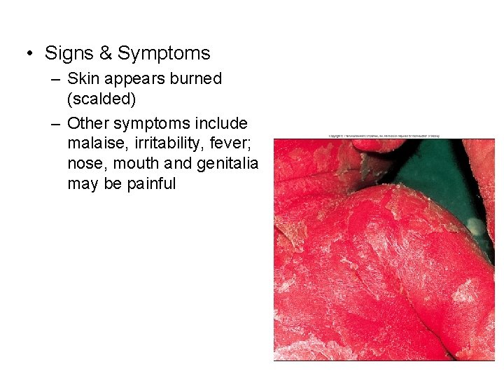  • Signs & Symptoms – Skin appears burned (scalded) – Other symptoms include