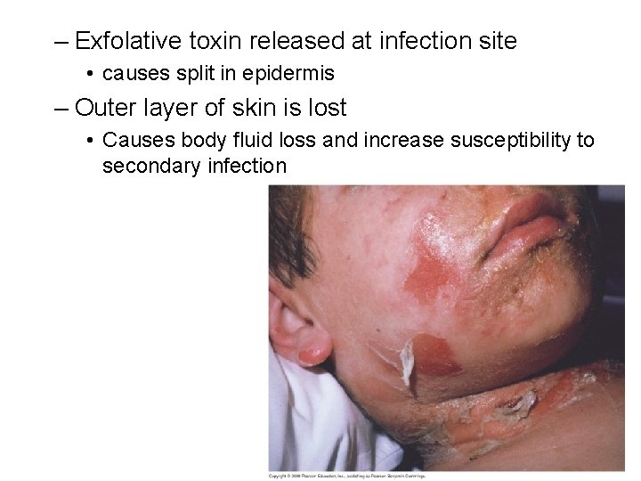 – Exfolative toxin released at infection site • causes split in epidermis – Outer