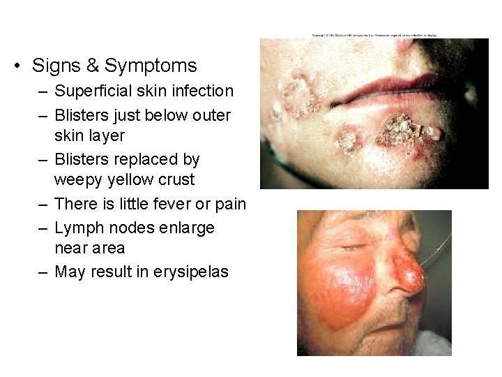  • Signs & Symptoms – Superficial skin infection – Blisters just below outer