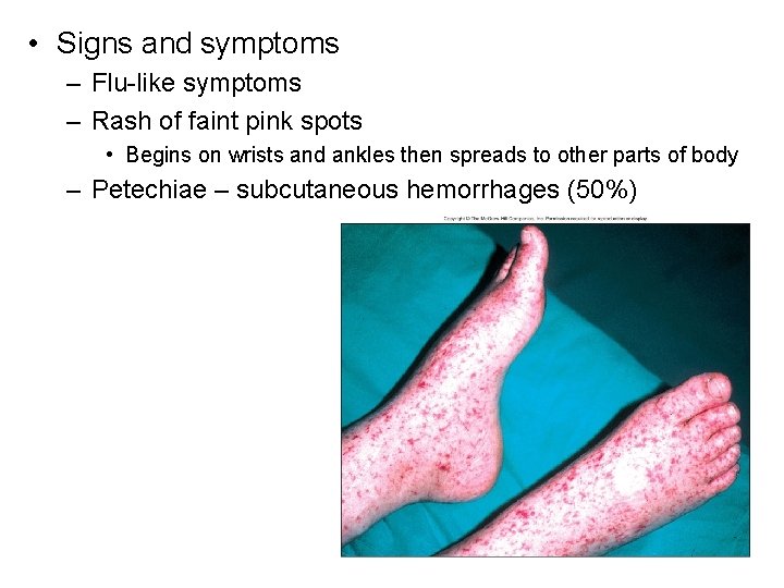  • Signs and symptoms – Flu-like symptoms – Rash of faint pink spots