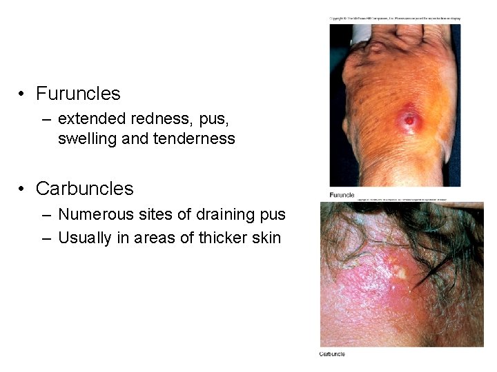  • Furuncles – extended redness, pus, swelling and tenderness • Carbuncles – Numerous