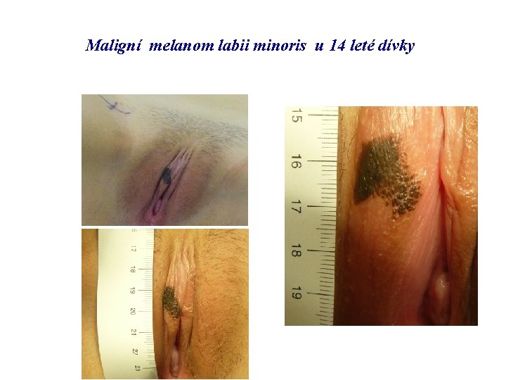 Maligní melanom labii minoris u 14 leté dívky 