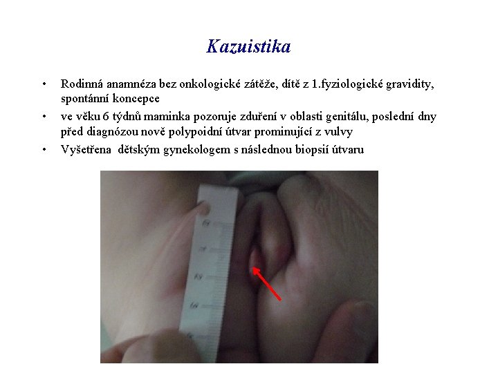 Kazuistika • • • Rodinná anamnéza bez onkologické zátěže, dítě z 1. fyziologické gravidity,
