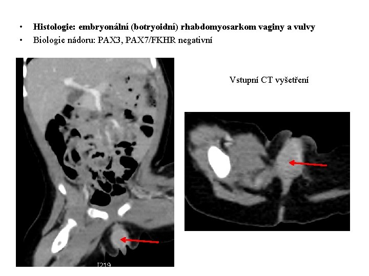  • • Histologie: embryonální (botryoidní) rhabdomyosarkom vaginy a vulvy Biologie nádoru: PAX 3,
