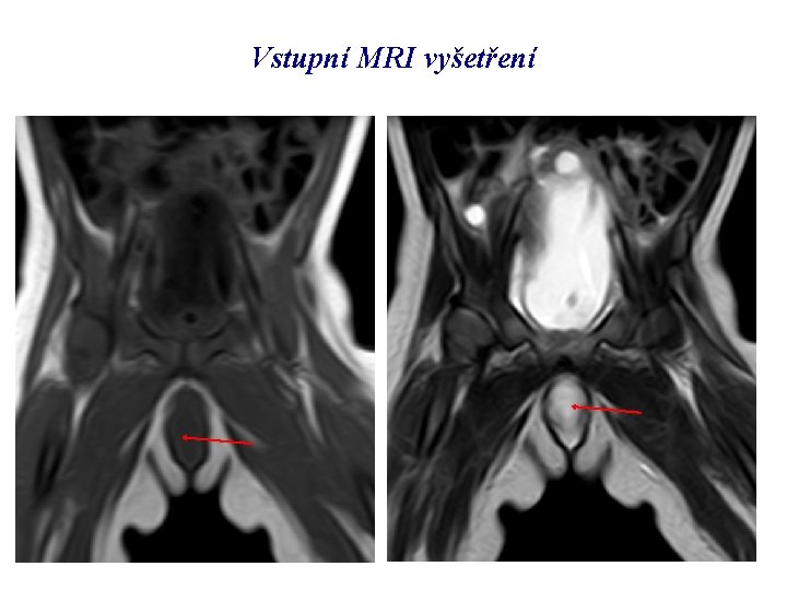 Vstupní MRI vyšetření 