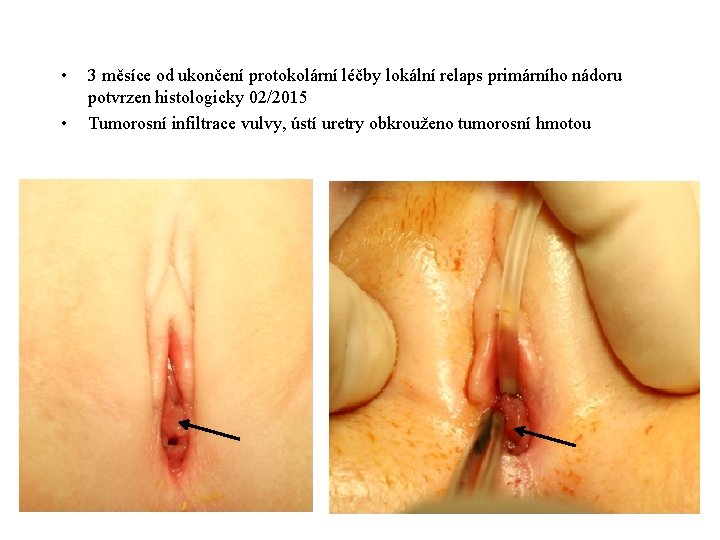  • • 3 měsíce od ukončení protokolární léčby lokální relaps primárního nádoru potvrzen