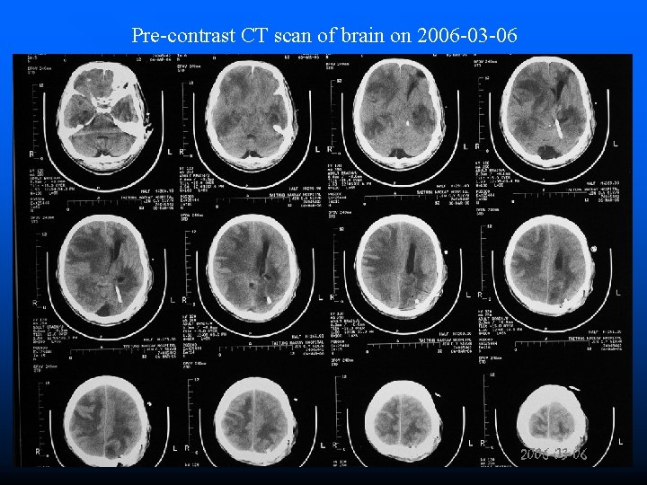 Pre-contrast CT scan of brain on 2006 -03 -06 