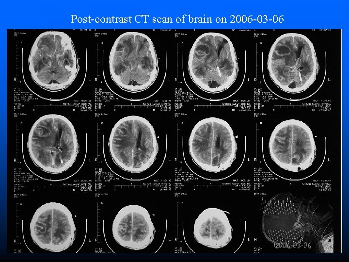 Post-contrast CT scan of brain on 2006 -03 -06 