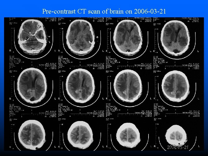 Pre-contrast CT scan of brain on 2006 -03 -21 