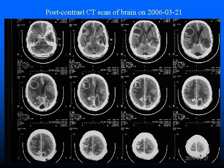 Post-contrast CT scan of brain on 2006 -03 -21 