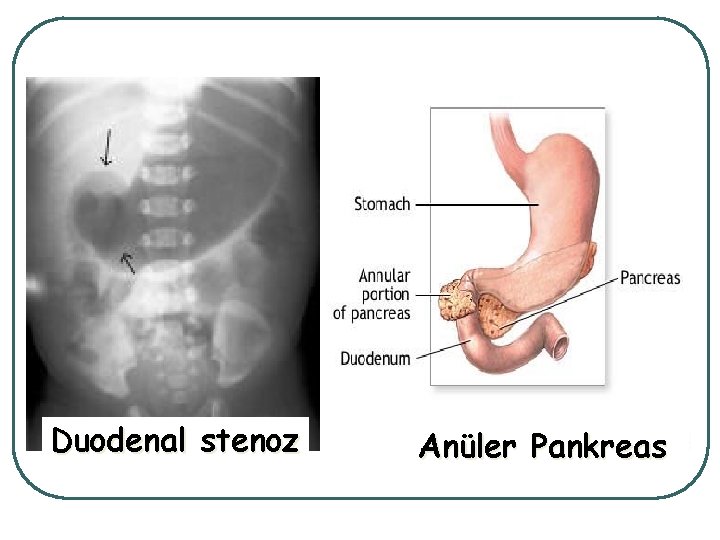 Duodenal stenoz Anüler Pankreas 
