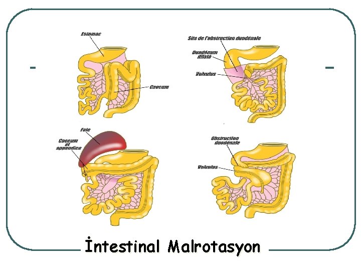 İntestinal Malrotasyon 