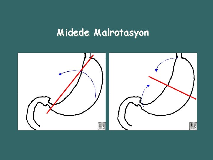 Midede Malrotasyon 