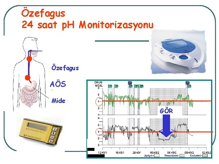 Özefagus 24 saat p. H Monitorizasyonu Özefagus AÖS Mide GÖR 