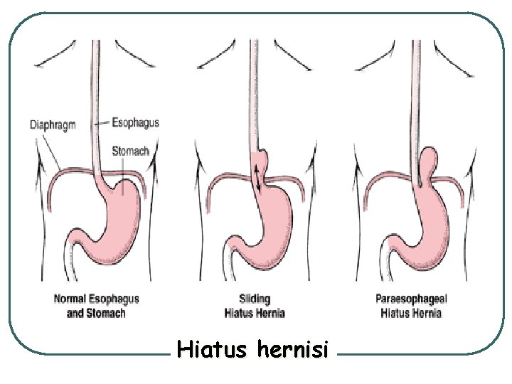 Hiatus hernisi 