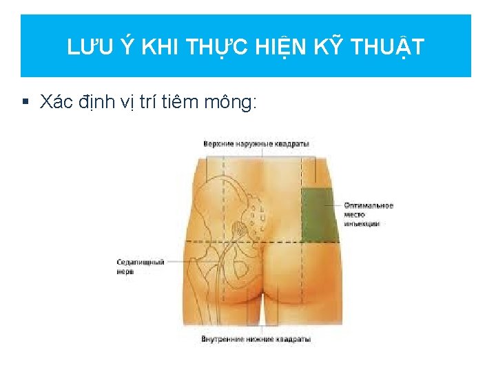 LƯU Ý KHI THỰC HIỆN KỸ THUẬT § Xác định vị trí tiêm mông: