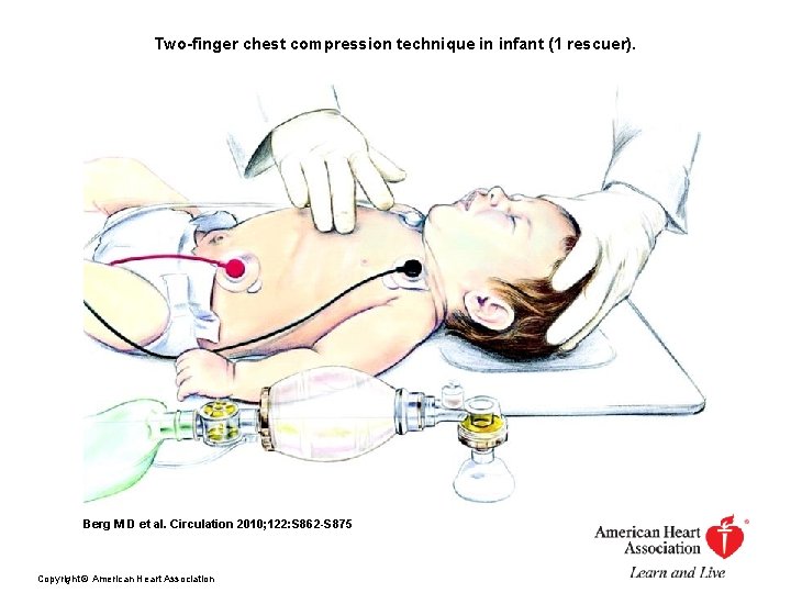 Two-finger chest compression technique in infant (1 rescuer). Berg M D et al. Circulation