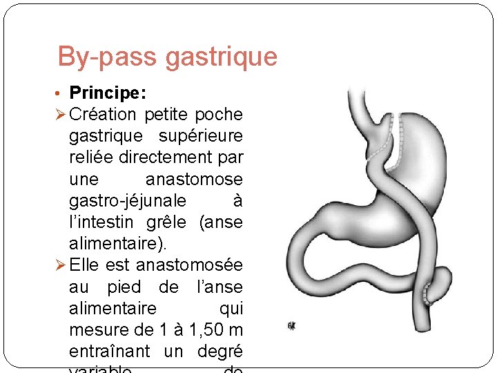 By-pass gastrique • Principe: Création petite poche gastrique supérieure reliée directement par une anastomose