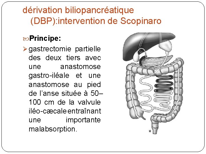 dérivation biliopancréatique (DBP): intervention de Scopinaro Principe: gastrectomie partielle des deux tiers avec une