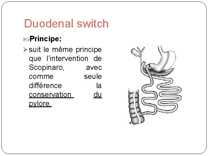 Duodenal switch Principe: suit le même principe que l’intervention de Scopinaro, avec comme seule