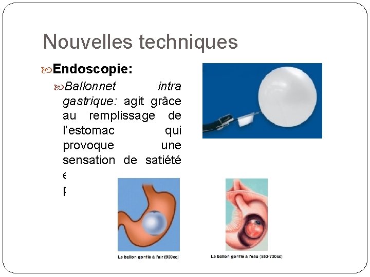 Nouvelles techniques Endoscopie: Ballonnet intra gastrique: agit grâce au remplissage de l’estomac qui provoque