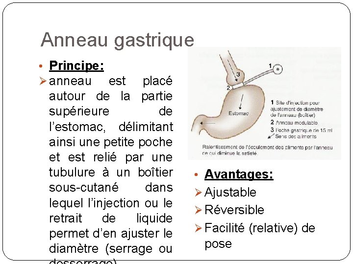 Anneau gastrique • Principe: anneau est placé autour de la partie supérieure de l’estomac,