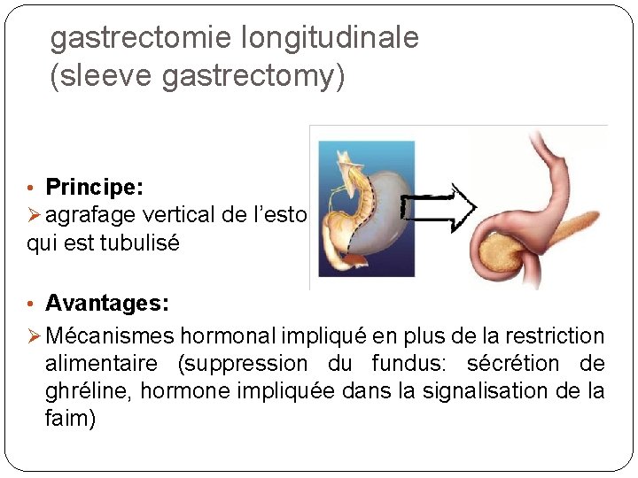 gastrectomie longitudinale (sleeve gastrectomy) • Principe: agrafage vertical de l’estomac, qui est tubulisé •