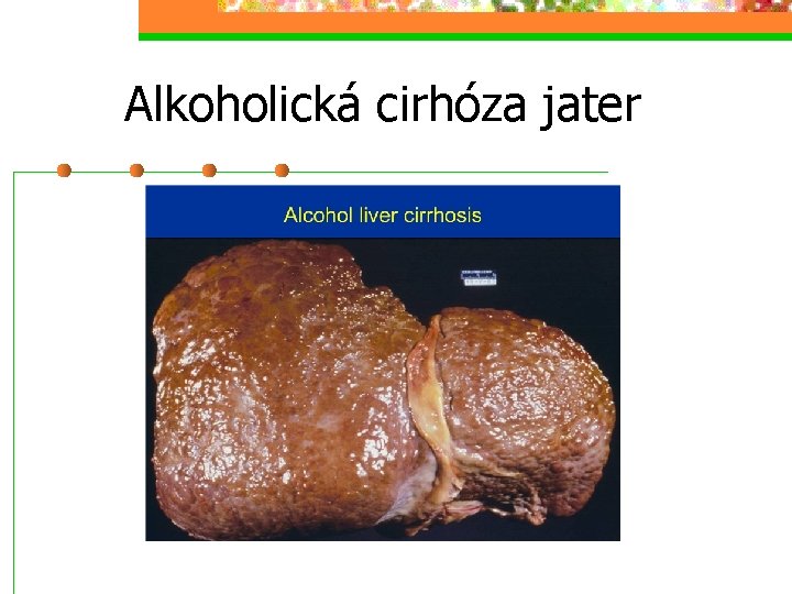 Alkoholická cirhóza jater 