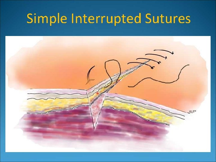Simple Interrupted Sutures 