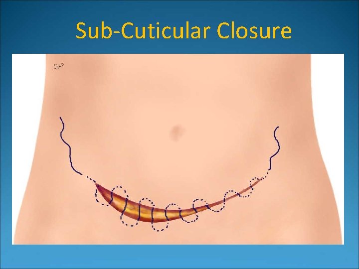 Sub-Cuticular Closure 