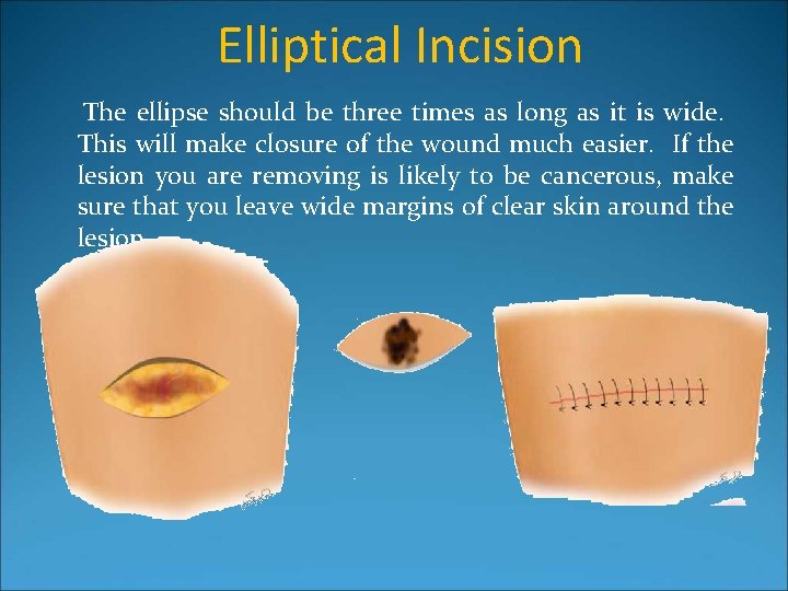 Elliptical Incision The ellipse should be three times as long as it is wide.